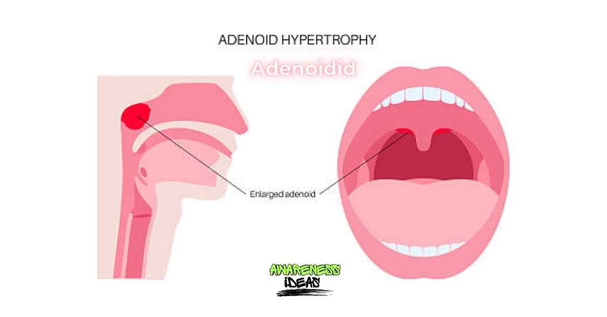 adenoidid