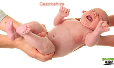 gastroshiza