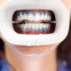 teeth whitening