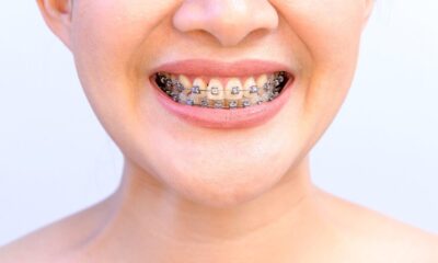 Accelerated Orthodontics: How to Get Straighter Teeth Faster