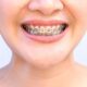 Accelerated Orthodontics: How to Get Straighter Teeth Faster
