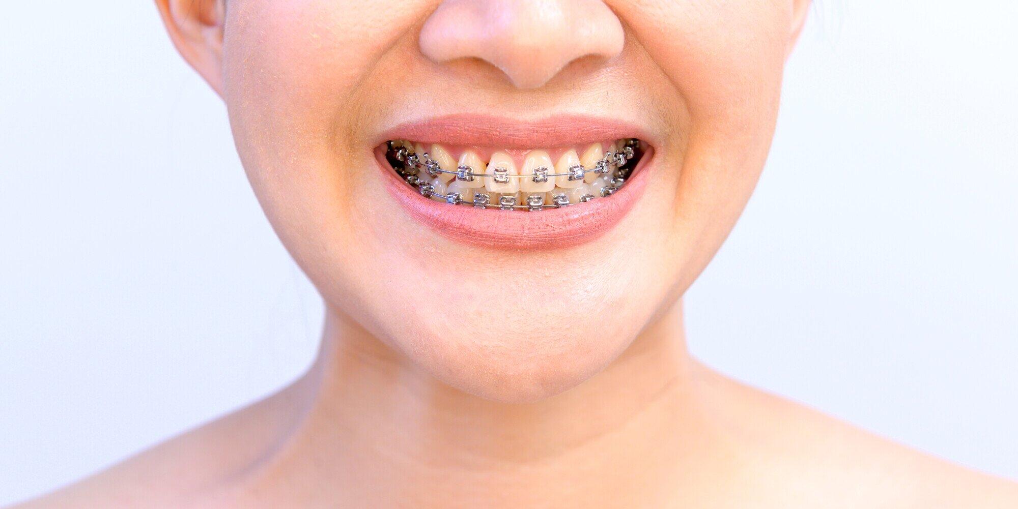 Accelerated Orthodontics: How to Get Straighter Teeth Faster