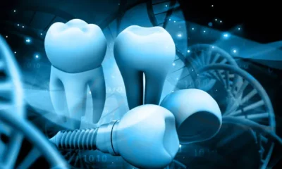 dental implants