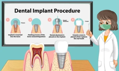 dental implants Queens