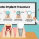 dental implants Queens