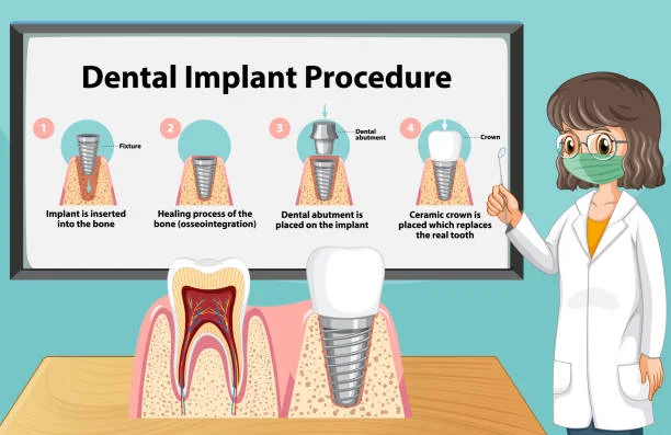 dental implants Queens