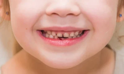 baby teeth to permanent teeth