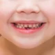 baby teeth to permanent teeth